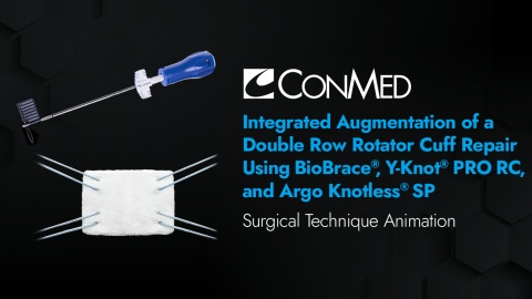 Integrated Augmentation of Double Row Rotator Cuff Repair Using BioBrace®, Y-Knot® PRO RC, and Argo Knotless® SP