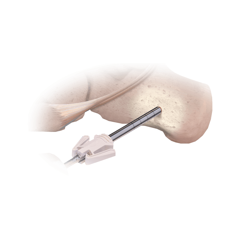 CoLink<sup>®</sup> Bone Graft Harvester
