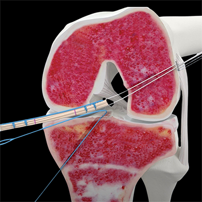 Ortopédicos para rodilla